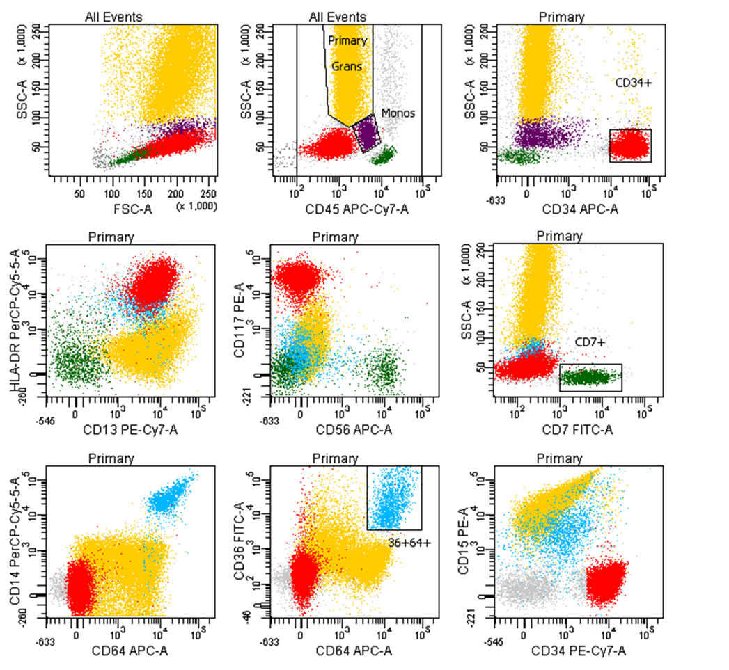Image 4. Flow cytometric analysis identified a population of blasts with expression of CD34, CD117, HLA-DR, CD13, subset CD4 (not shown), subset CD33. The blasts are negative for CD45 and monocytic markers.